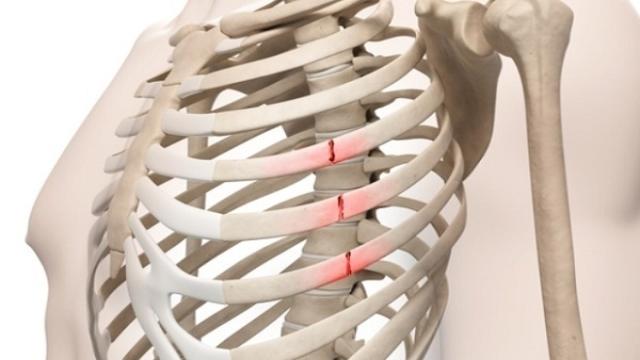 gãy xương sườn cũng gây ra các triệu chứng đau cơ hoành